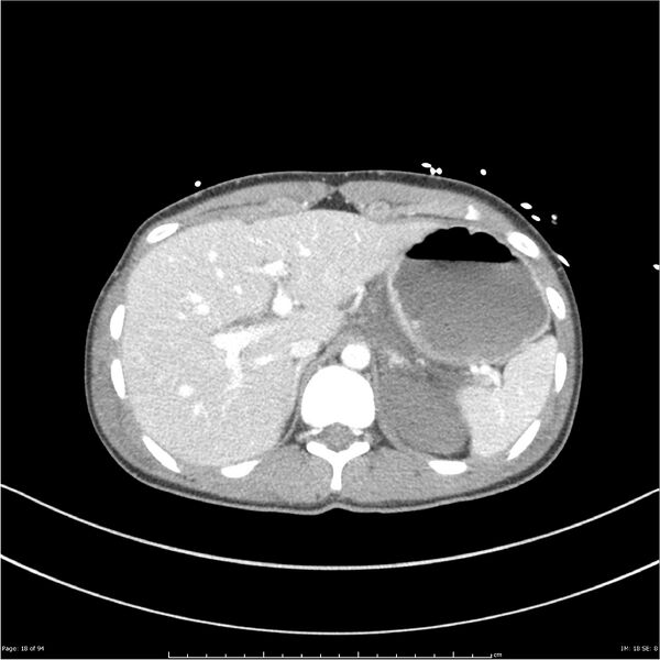 File:Traumatic renal artery dissection and pancreatic transection (Radiopaedia 37061-38739 Axial 267).jpg