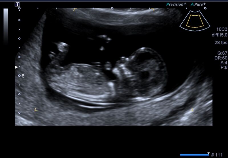File:1st trimester nuchal-morphology ultrasound (Radiopaedia 44706-48477 General anatomy and NT 1).jpg