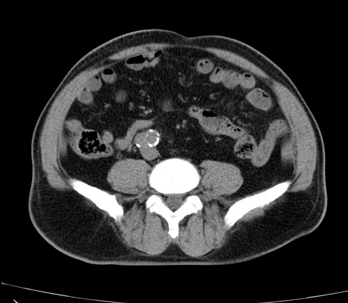 File:Abdominal aortic aneurysm (Radiopaedia 22421-22458 non-contrast 34).jpg