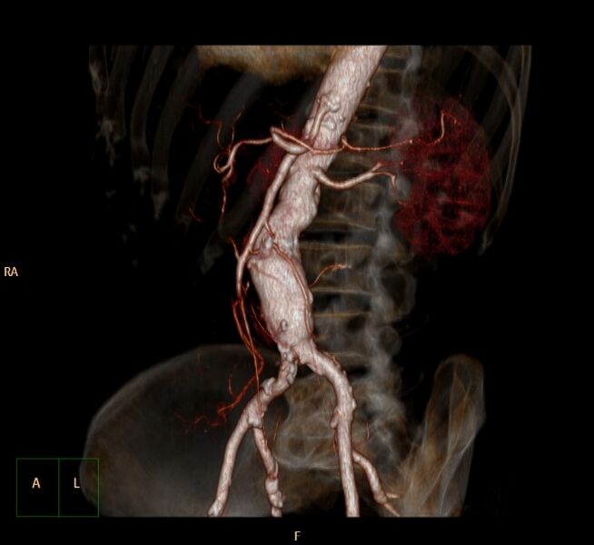 File:Abdominal aortic aneurysm (Radiopaedia 23703-23856 3D 23).jpg