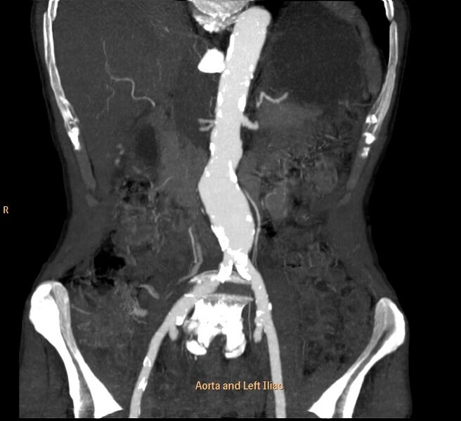 File:Abdominal aortic aneurysm (Radiopaedia 23703-23856 F 2).jpg