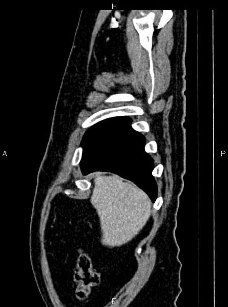 File:Abdominal aortic aneurysm (Radiopaedia 83094-97462 Sagittal renal cortical phase 17).jpg