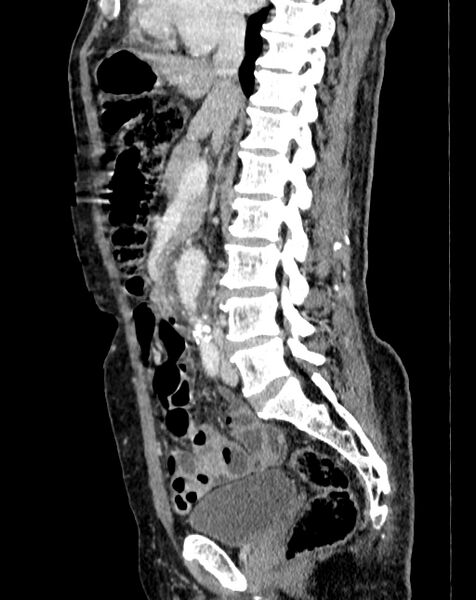 File:Abdominal aortic aneurysm (Radiopaedia 83581-98689 Sagittal C+ portal venous phase 41).jpg