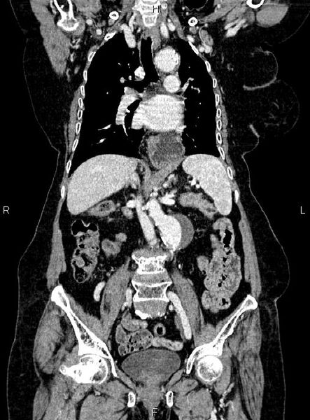 File:Abdominal aortic aneurysm (Radiopaedia 85063-100606 Coronal C+ arterial phase 30).jpg