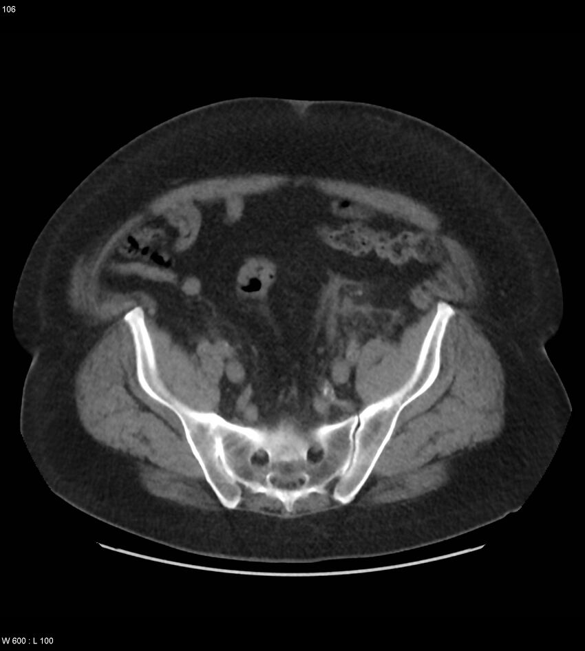 Abdominal aortic aneurysm with intramural hematoma then rupture (Radiopaedia 50278-55631 Axial non-contrast 102).jpg