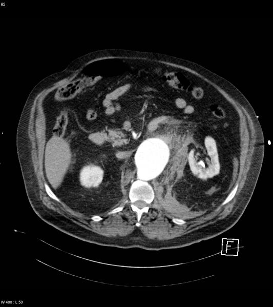 File:Abdominal aortic aneurysm with intramural hematoma then rupture (Radiopaedia 50278-55632 Axial C+ arterial phase 64).jpg