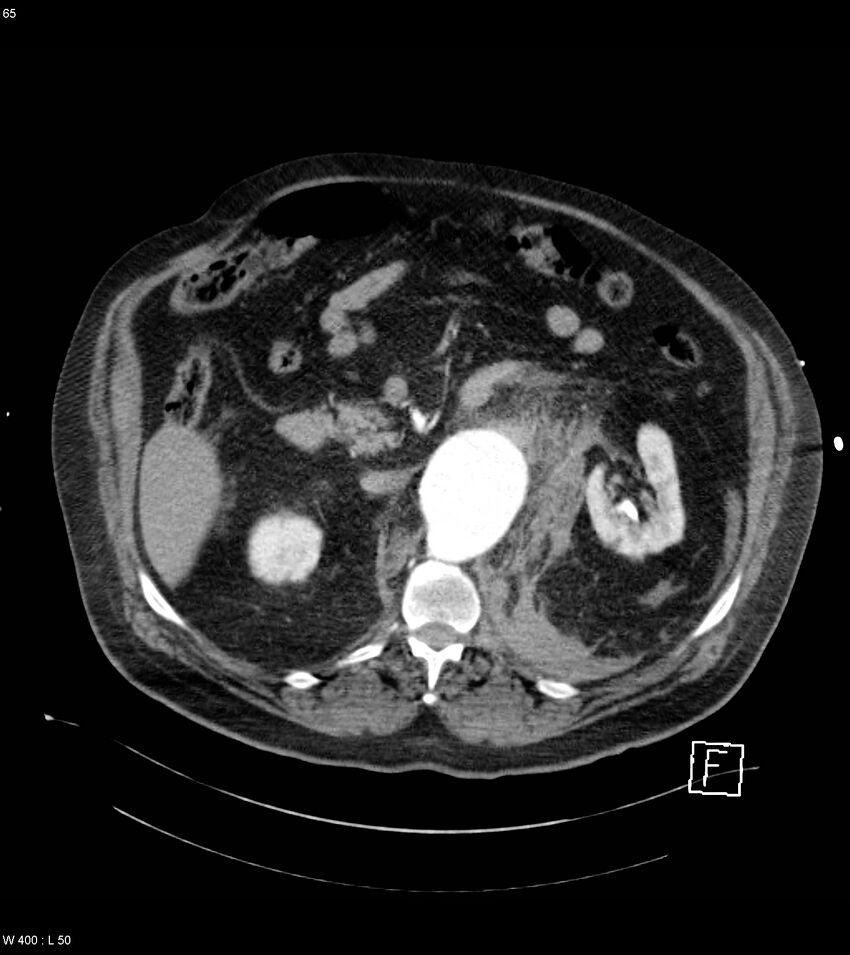 Abdominal aortic aneurysm with intramural hematoma then rupture (Radiopaedia 50278-55632 Axial C+ arterial phase 64).jpg
