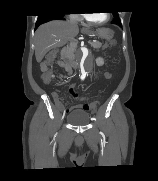File:Abdominal aortic aneurysm with thrombus fissuration (Radiopaedia 46218-50618 Coronal C+ arterial phase 22).jpg