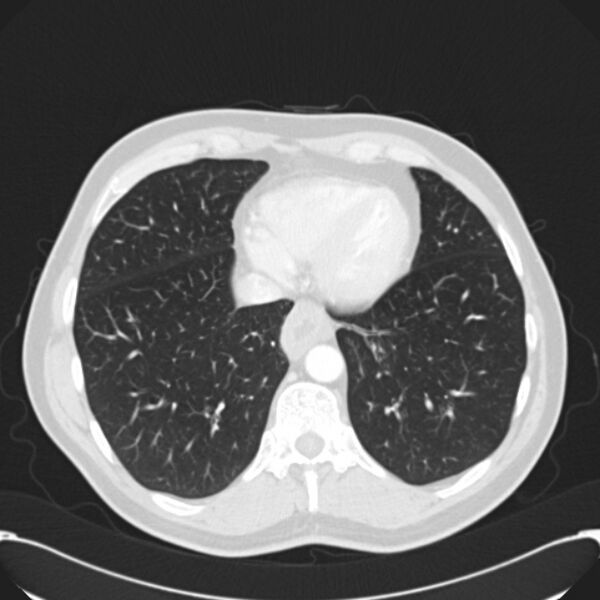 File:Achalasia (Radiopaedia 24937-25206 Axial lung window 26).jpg