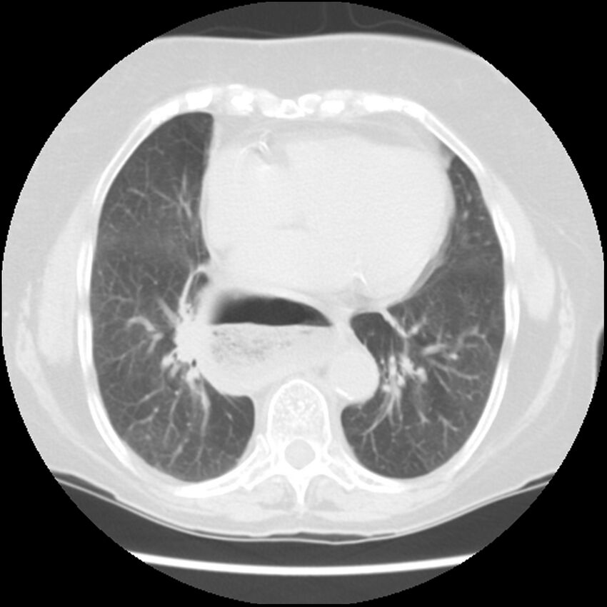 Achalasia (Radiopaedia 44094-47649 Axial lung window 38).jpg