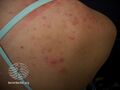 Acne affecting the back images (DermNet NZ acne-acne-back-152).jpg