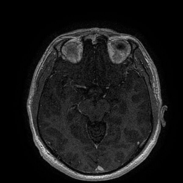 File:Acoustic schwannoma - intracanalicular (Radiopaedia 37247-39024 Axial T1 C+ 111).jpg