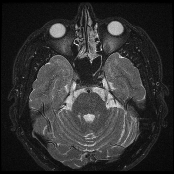 File:Acoustic schwannoma - intracanalicular (Radiopaedia 37247-39024 Axial T2 fat sat 10).jpg