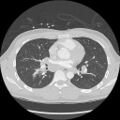 Active right ventricular cardiac sarcoidosis (Radiopaedia 55596-62101 Axial lung window 23).jpg