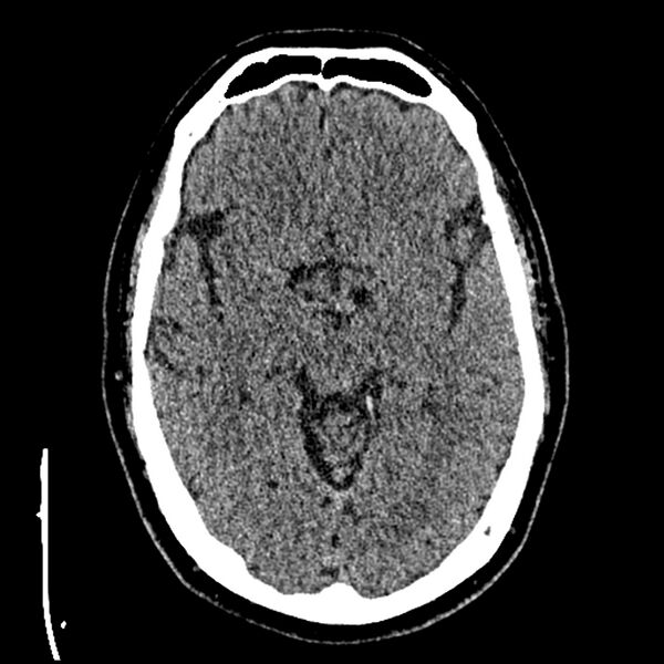 File:Acute A3 occlusion with ACA ischemic penumbra (CT perfusion) (Radiopaedia 72036-82525 Axial non-contrast thins 17).jpg