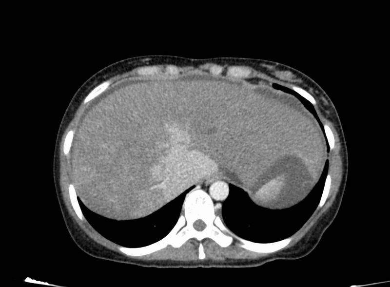 File:Acute Budd-Chiari syndrome (Radiopaedia 60858-68638 Axial C+ portal venous phase 40).jpg