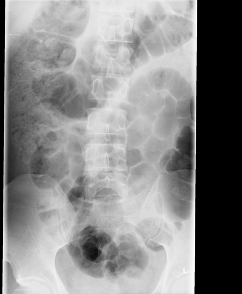 File:Acute L1 burst compression fracture (Radiopaedia 34430-35754 Frontal 1).png