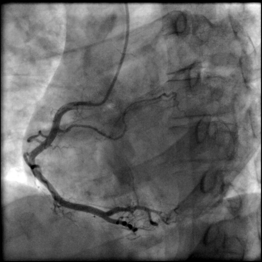 Acute anteroseptal myocardial infarction (Radiopaedia 68409-77946 RAO straight RCA 35).jpg