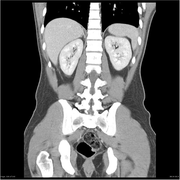 File:Acute appendicitis (Radiopaedia 25364-25615 C+ portal venous phase 23).jpg