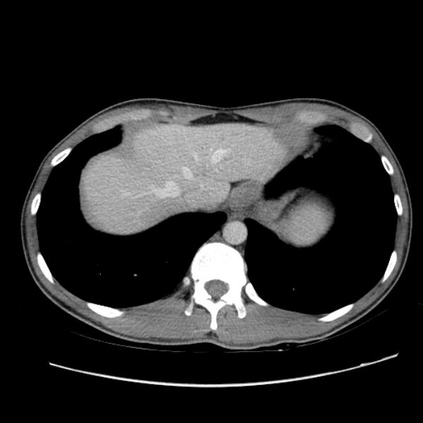 File:Acute appendicitis (Radiopaedia 27049-27227 Axial C+ portal venous phase 9).jpg