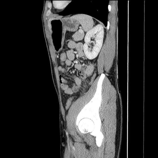 File:Acute appendicitis (Radiopaedia 27049-27227 Sagittal C+ portal venous phase 60).jpg