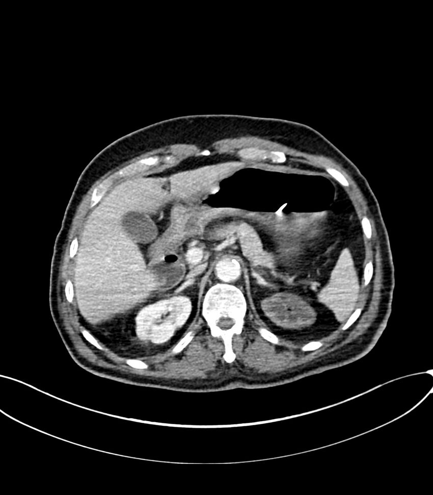 Acute arterial mesenteric ischemia (Radiopaedia 78238-90828 Axial C+ portal venous phase 40).jpg