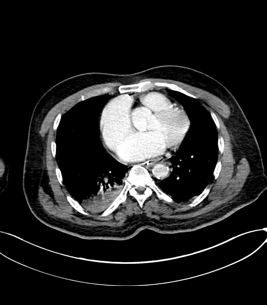 Acute arterial mesenteric ischemia (Radiopaedia 78238-90828 Axial C+ portal venous phase 7).jpg