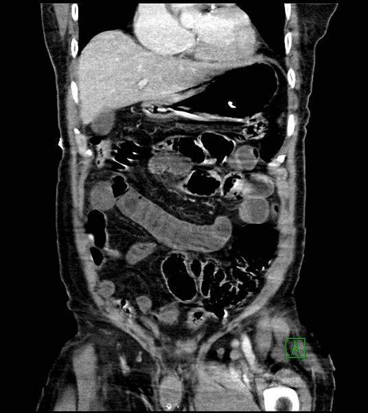 File:Acute arterial mesenteric ischemia (Radiopaedia 78238-90828 Coronal C+ portal venous phase 34).jpg