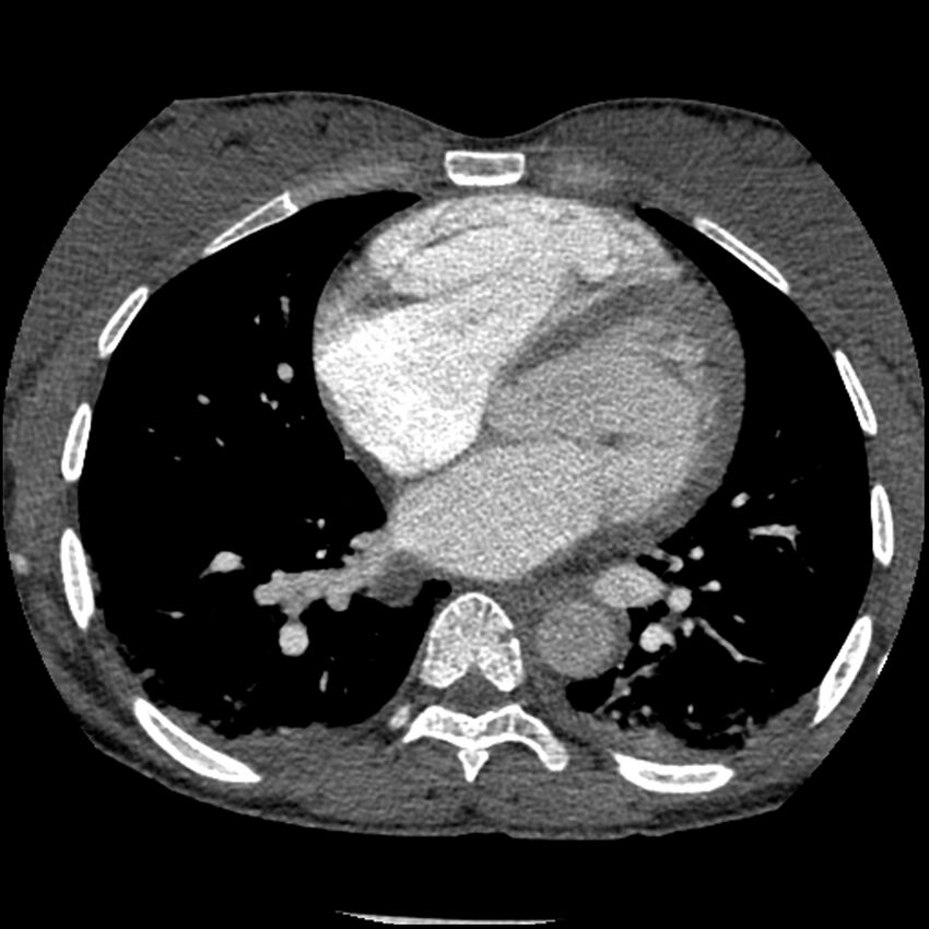 Acute chest syndrome - sickle cell disease (Radiopaedia 42375-45499 Axial C+ CTPA 113).jpg