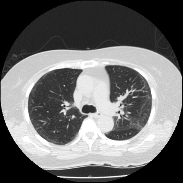 File:Acute interstitial pneumonitis (Radiopaedia 45404-49444 Axial lung window 41).jpg