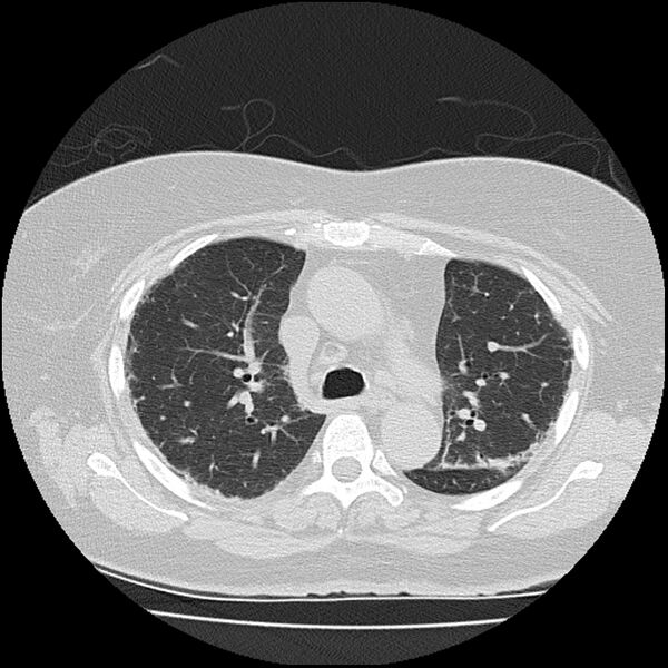 File:Acute interstitial pneumonitis (Radiopaedia 45404-49452 Axial lung window 34).jpg
