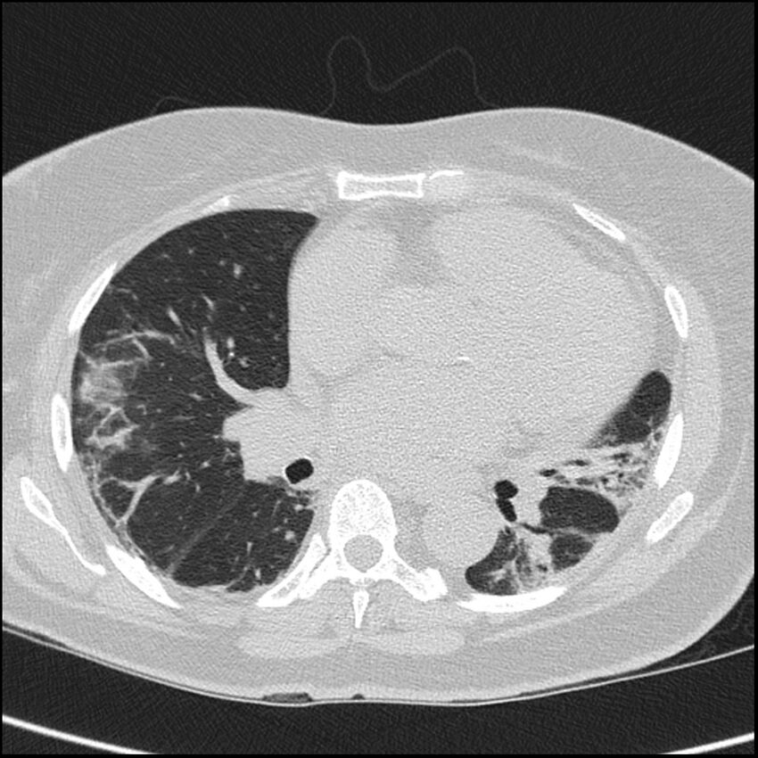 Acute interstitial pneumonitis (Radiopaedia 45404-49453 Axial lung window 46).jpg