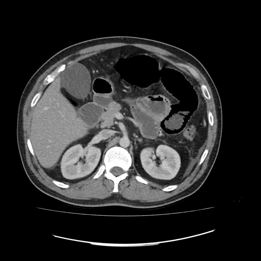 Acute mesenteric ischemia - superior mesenteric artery thrombosis (Radiopaedia 73947-84776 Axial C+ portal venous phase 31).jpg