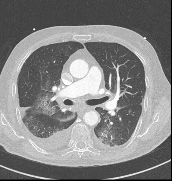 File:Acute myocardial infarction (Radiopaedia 23413-23481 lung window 21).jpg