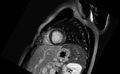 Acute myocarditis (Radiopaedia 77023-88967 Short axis stack LGE 4).jpg