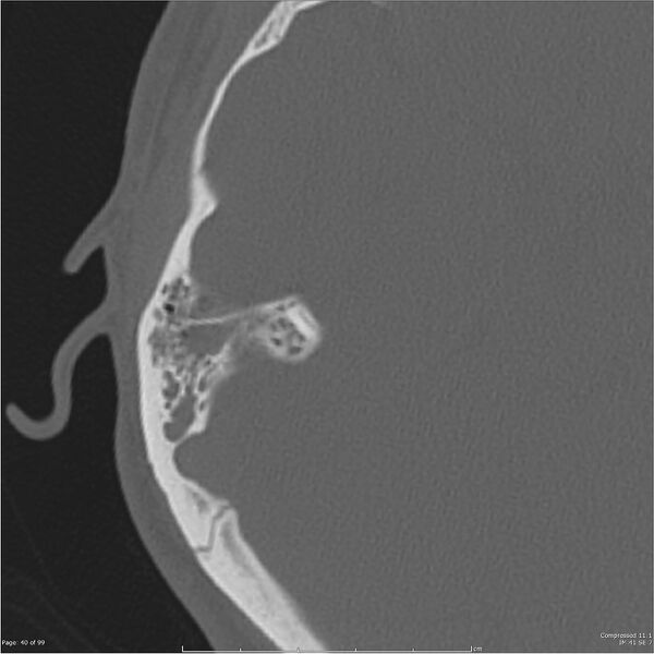 File:Acute otomastoiditis (Radiopaedia 28276-28512 Axial PTB bone window reformat 20).jpg