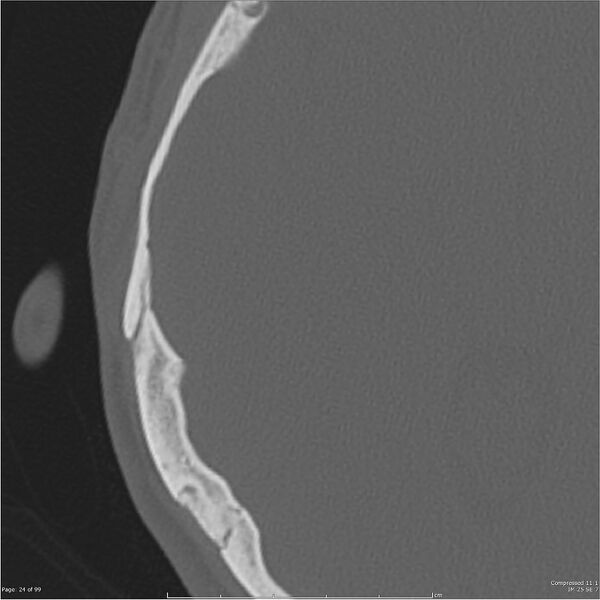 File:Acute otomastoiditis (Radiopaedia 28276-28512 Axial PTB bone window reformat 4).jpg