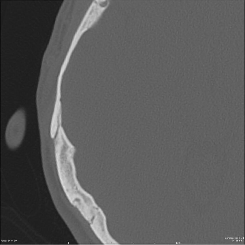 Acute otomastoiditis (Radiopaedia 28276-28512 Axial PTB bone window reformat 4).jpg