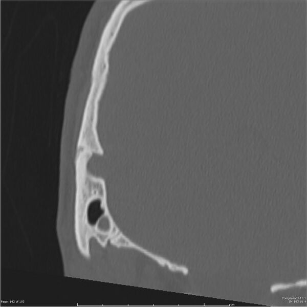 File:Acute otomastoiditis (Radiopaedia 28276-28512 Coronal PTB bone window reformat 73).jpg