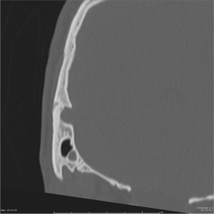 Acute otomastoiditis (Radiopaedia 28276-28512 Coronal PTB bone window reformat 73).jpg