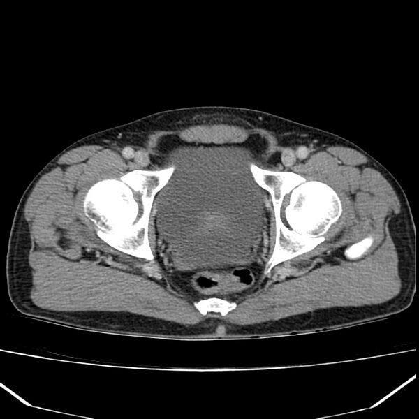 File:Acute pancreatitis (Radiopaedia 22572-22596 Axial C+ portal venous phase 69).jpg