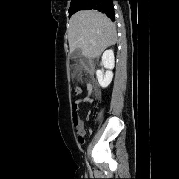 File:Acute pancreatitis (Radiopaedia 69236-79012 Sagittal C+ portal venous phase 69).jpg