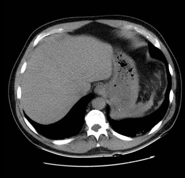 File:Acute pancreatitis - Balthazar E (Radiopaedia 23080-23110 Axial non-contrast 11).jpg