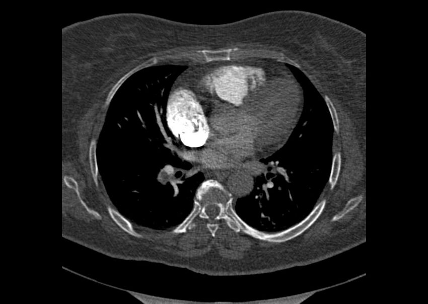 Acute pulmonary embolism (Radiopaedia 29938-30466 Axial C+ CTPA 109).jpg