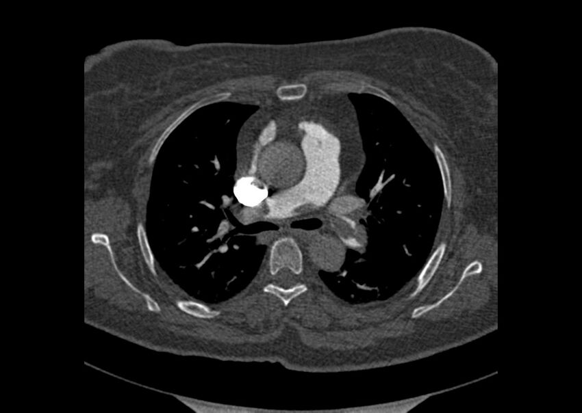 Acute pulmonary embolism (Radiopaedia 29938-30466 Axial C+ CTPA 50).jpg