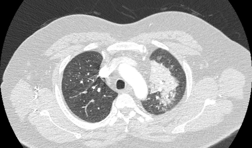 Acute pulmonary embolism with pulmonary infarcts (Radiopaedia 77688-89908 Axial lung window 20).jpg