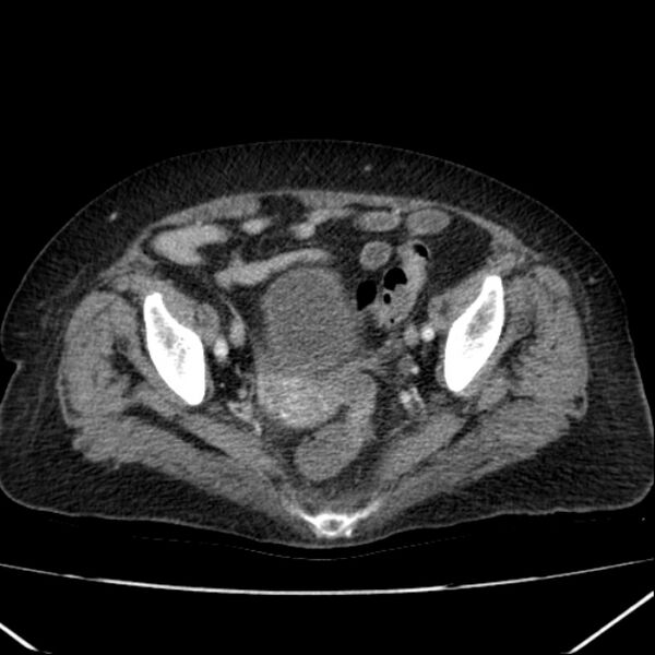 File:Acute pyelonephritis (Radiopaedia 26584-26729 Axial renal cortical phase 63).jpg