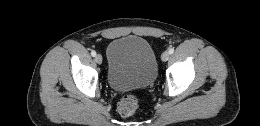 Acute sigmoid colon diverticulitis (Radiopaedia 55507-61976 Axial C+ portal venous phase 107).jpg