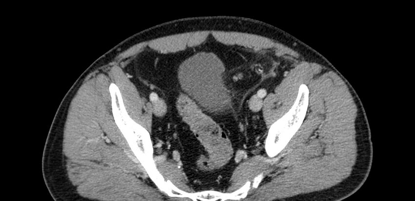 Acute sigmoid colon diverticulitis (Radiopaedia 55507-61976 Axial C+ portal venous phase 94).jpg