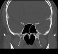 Acute sinusitis (Radiopaedia 23161-23215 Coronal bone window 47).jpg